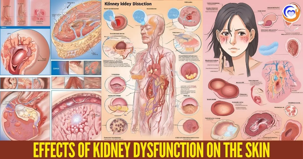 Effects-of-Kidney-Dysfunction-on-the-Skin