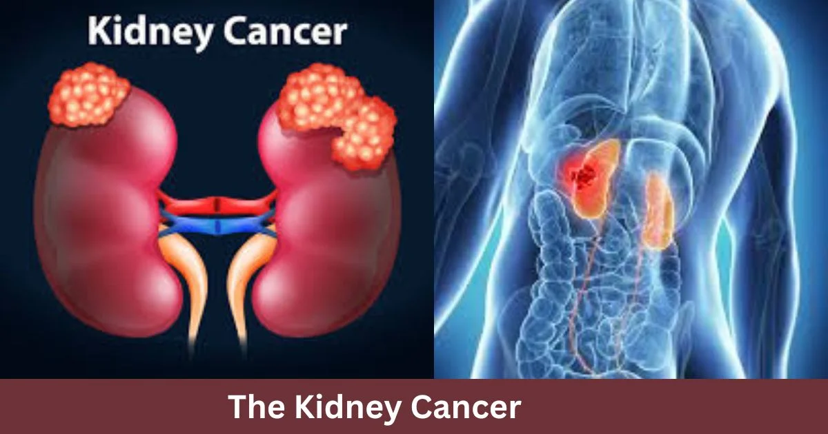 The Kidney Cancer